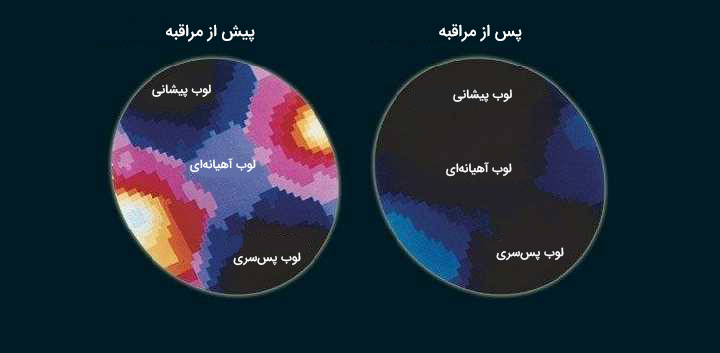 تاثیر مراقبه بر مغز